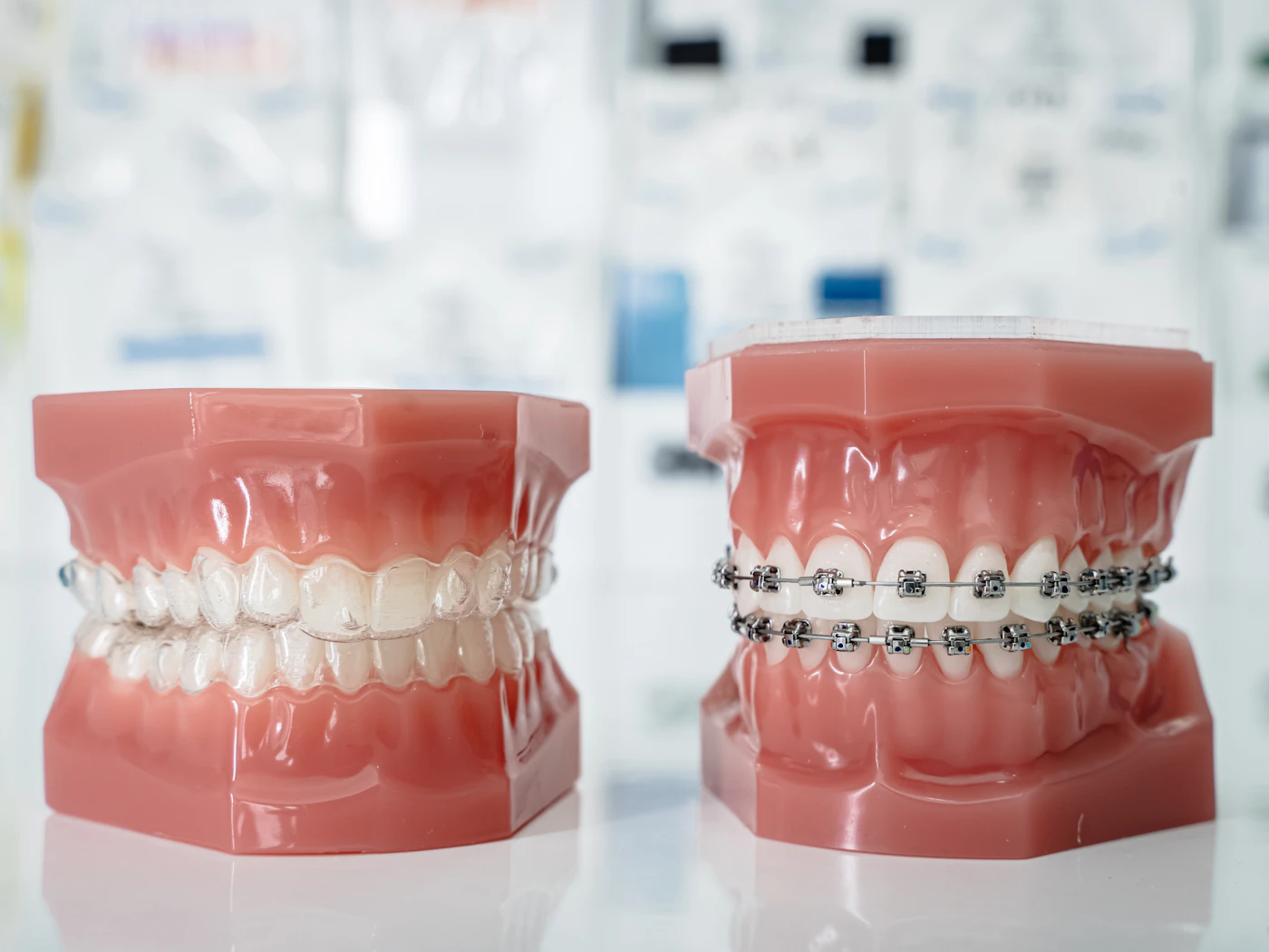 Two dental models comparing ceramic and metal braces
