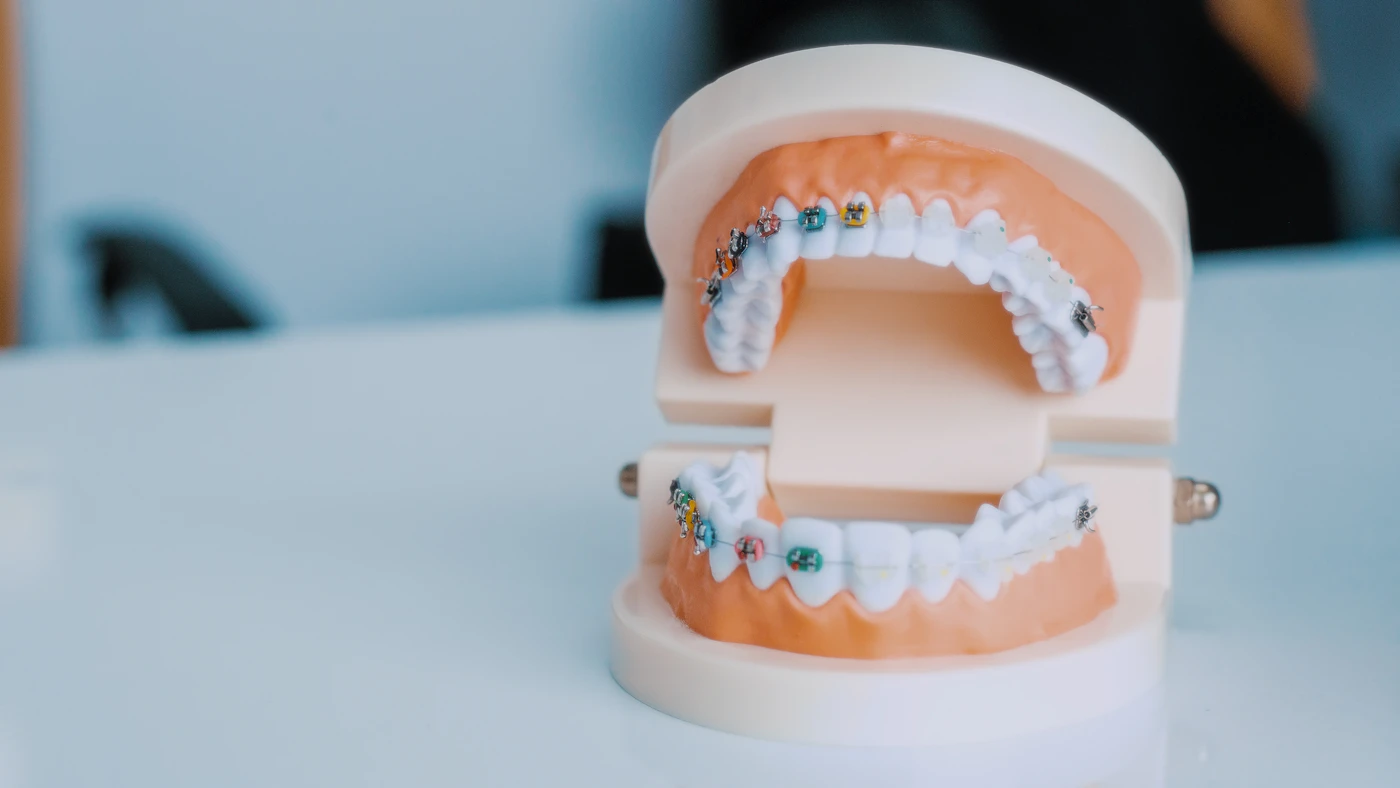 Dental model with colorful braces